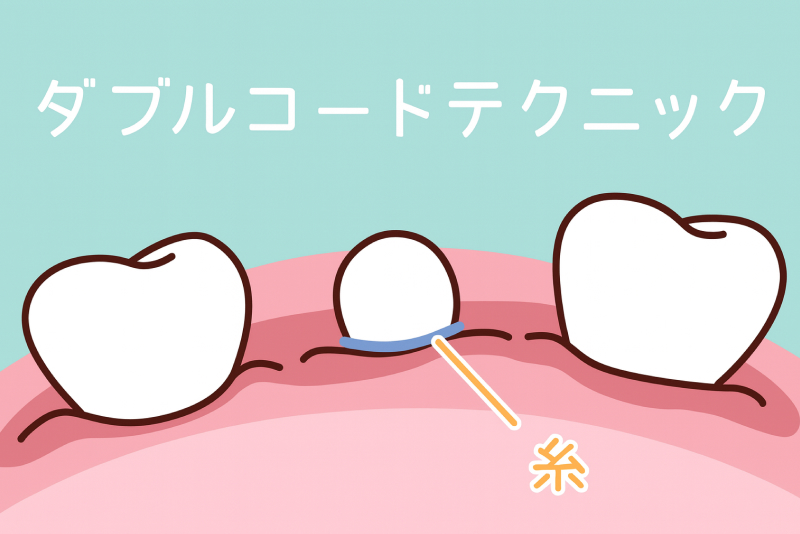 2. きれいに型とりするための処置「ダブルコードテクニック」