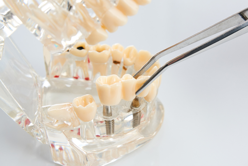 インプラント義歯