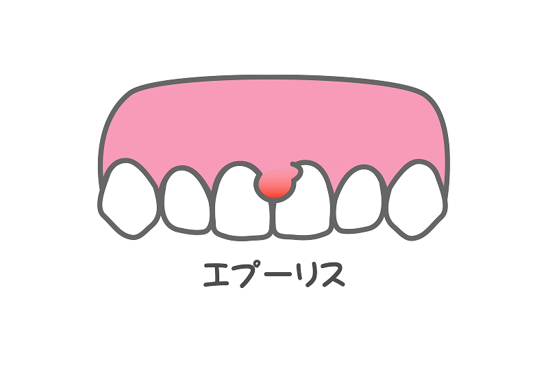 妊娠性エプーリス