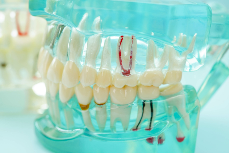 虫歯・歯周病のリスク